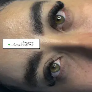 کاشت مژه هستی