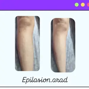 markz epilasion arad1 مرکز اپیلاسیون آراد بهترین مرکز اپیلاسیون در مشهد