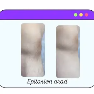 markz epilasion arad3 مرکز اپیلاسیون آراد بهترین مرکز اپیلاسیون در مشهد