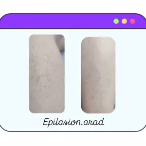 markz epilasion arad5 مرکز اپیلاسیون آراد بهترین مرکز اپیلاسیون در مشهد