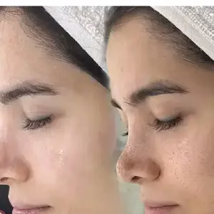 markz oksir javani2 مرکز اکسیر جوانی مرکز فشیال پوست مشهد