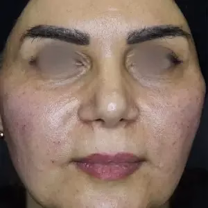 markz oksir javani4 مرکز اکسیر جوانی مرکز فشیال پوست مشهد