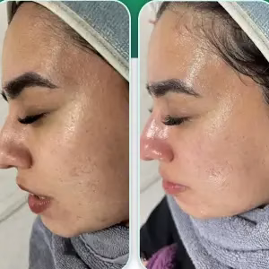 noavaran zibayi2 مرکز فشیال پوست مشهد