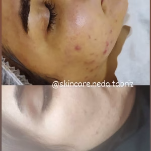 Neda facial center (3) مرکز فیشیال ندا، بهترین مرکز فیشیال در تبریز