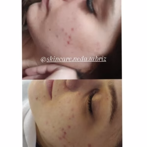 Neda facial center (4) مرکز فیشیال ندا، بهترین مرکز فیشیال در تبریز